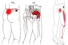 Bel Fıtığı Ayak Uyuşması Nasıl Geçer?