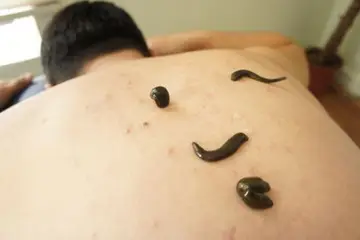 Bel Fıtığı Sülük Tedavisi