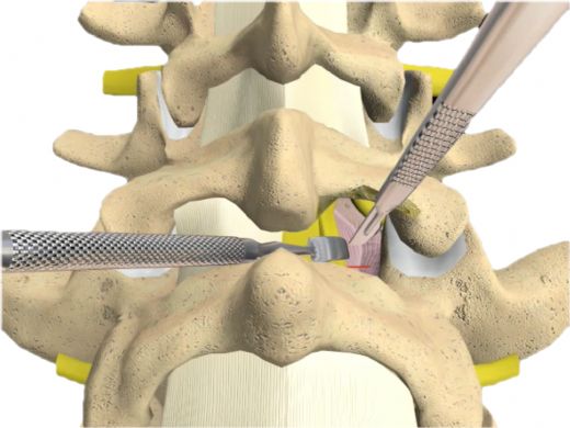 Bel Fıtığı Ameliyatı Riskleri ve Sonrası